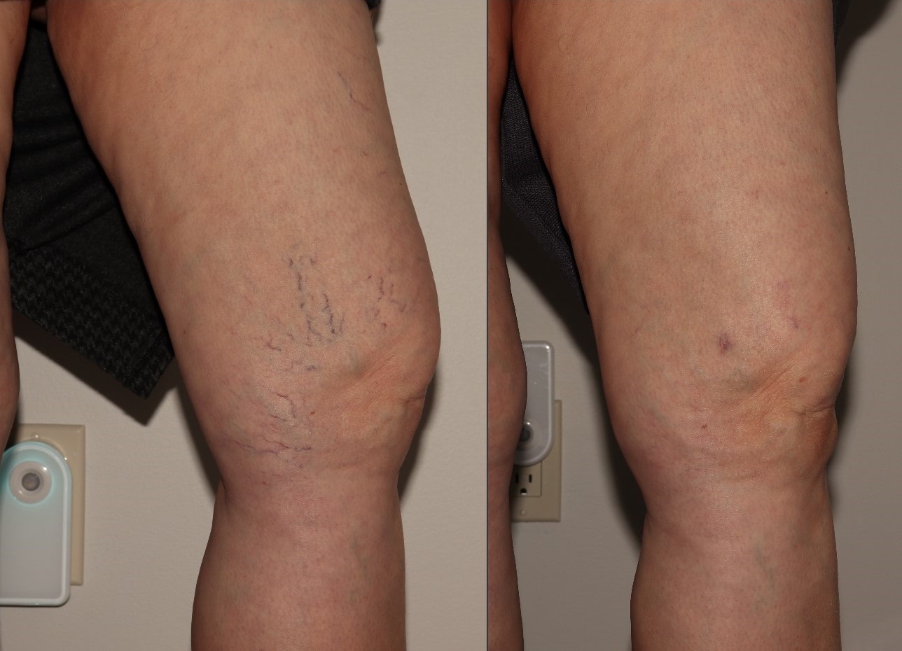 Fall Vein Treatment - It's the Perfect Time! Vein Specialists of